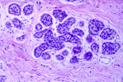 Гиперплазия Гиперплазия