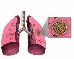Начальная форма аспергиллеза легких
