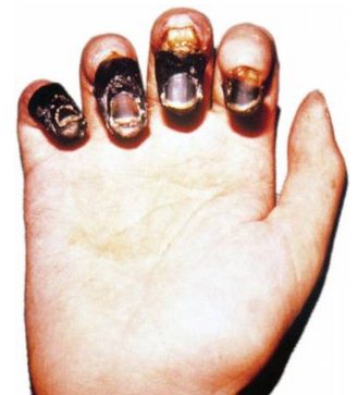 Поражение конечностей при заболевании чумой