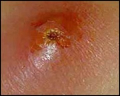 Фурункулез - заболевание инфекционного характера