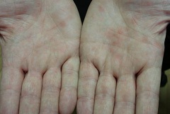 Иерсиоз - инфекционное заболевание