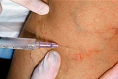 Склерозирование варикозных вен