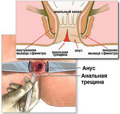 Лечение анального сфинктера 