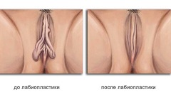 Интимная пластика больших половых губ - лабиопластика