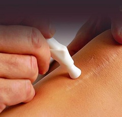 Процедура удаления растяжек лазером