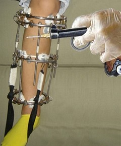 Аппарат Илизарова можно использовать для выравнивания конечностей Аппарат Илизарова можно использовать для выравнивания конечностей