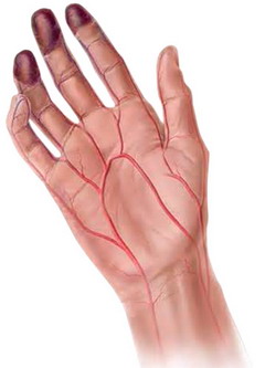 Болезнь Бюргера представляет собой облитерирующий тромбангиит