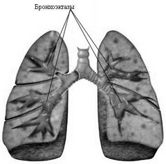 Бронхоэктаз — необратимые расширения части бронхиального дерева