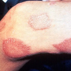 Гипопигментированные пятна - симптом лепры