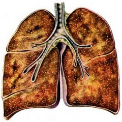 Милиарный туберкулез является острым заболеванием