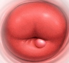 Ретенционная киста шейки матки