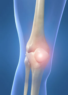 Ревматизм - воспалительное поражение соединительной ткани