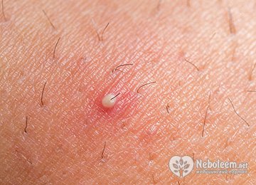 Эффективные способы удаления милиумов (белых угрей)