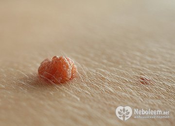 Принцип действия радиоволнового метода удаления родинок