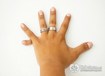 Полидактилия - излишнее число пальцев