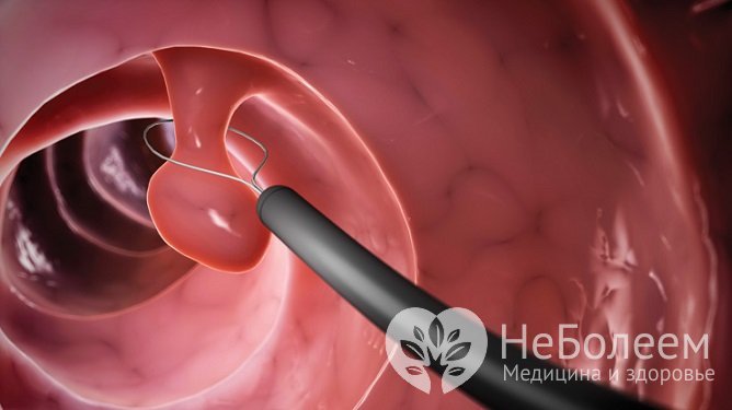 Эндоскопические операции – один из методов удаления полипов