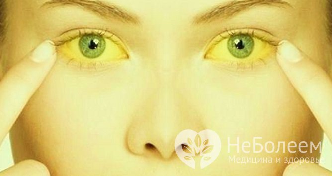 Желтуха – один из признаков ахолии