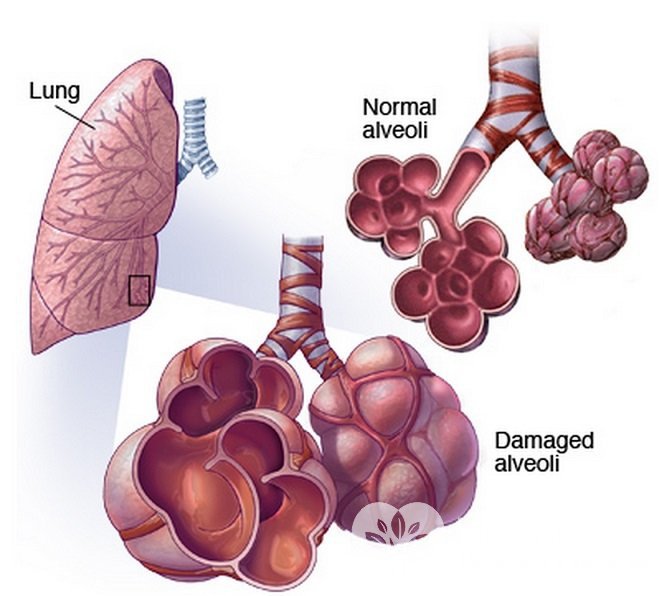 Альвеолит характеризуется воспалением легочных альвеол