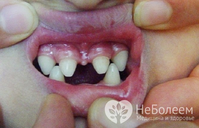 Для эктодермальной дисплазии характерна коническая форма передних зубов с острым режущим краем