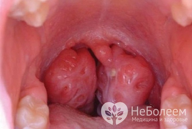 Горло при ангине Людвига