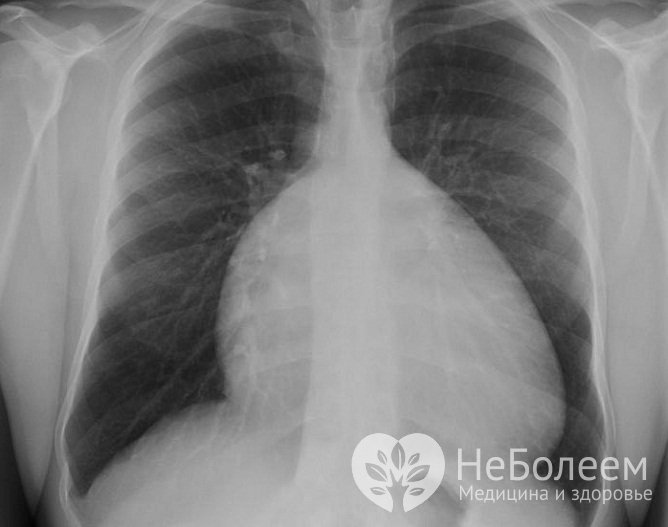 Рентгеновский снимок аномалии Эбштейна