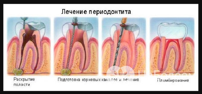 Процесс лечения апикального периодонтита