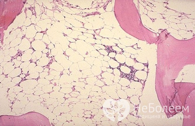 Апластическая анемия характеризуется снижением количества всех ферментных элементов крови