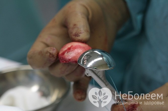 Эндопротезирование плечевого сустава показано на поздней стадии заболевания