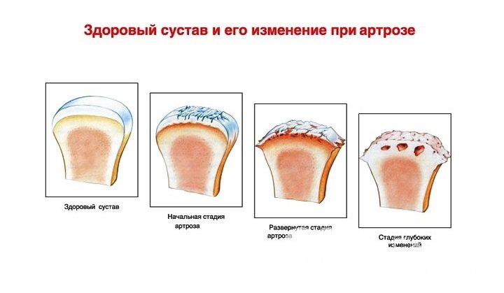 Признаки артроза