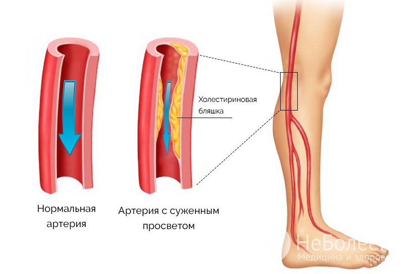 Признаки атеросклероза нижних конечностей