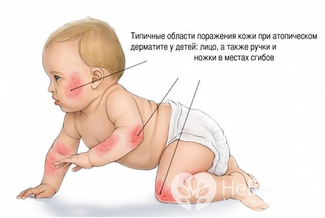 Распространенные области поражения при атопическом дерматите