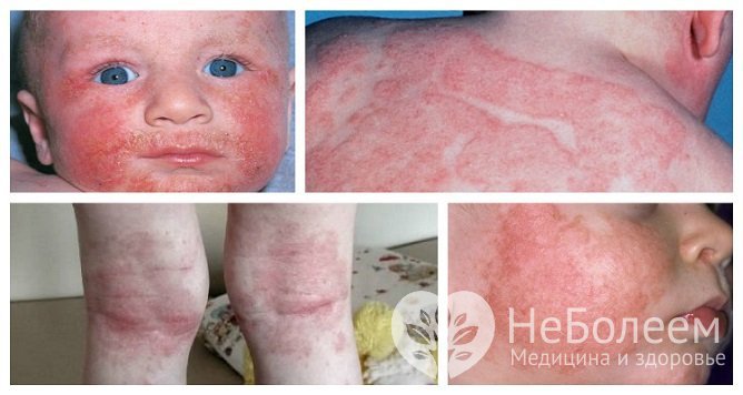 Внешние проявления атопического дерматита у детей