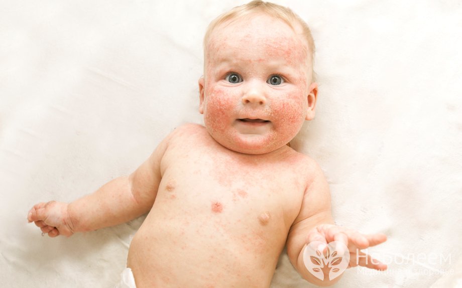 Симптомы атопического дерматита