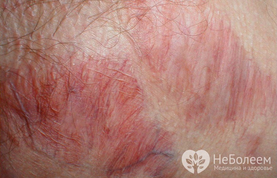 Симптомы атрофии кожи