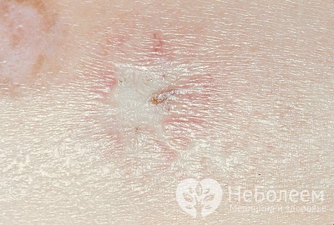 Белая атрофия кожи (атрофия Милиана)