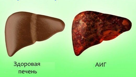 Как выглядит печень при аутоиммунном гепатите
