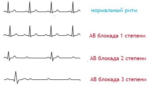 Степени атриовентрикулярной блокады сердца
