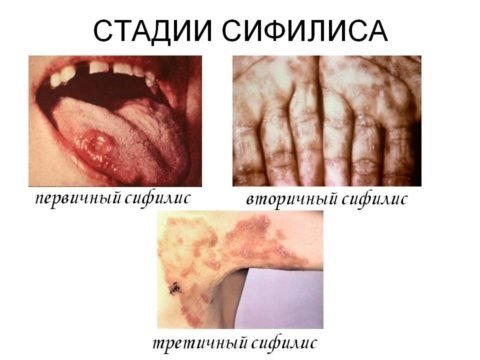 Стадии бытового сифилиса