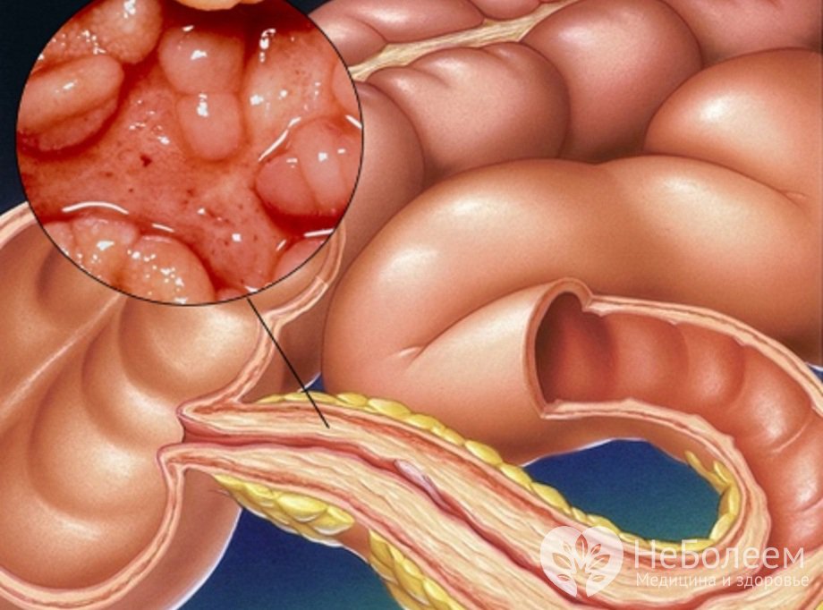 Признаки гастроэнтероколита