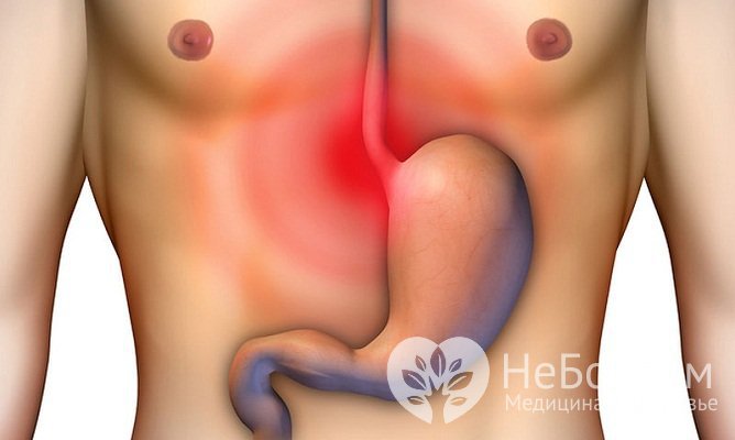 Изжога – основной симптом гастроэзофагеальной рефлюксной болезни