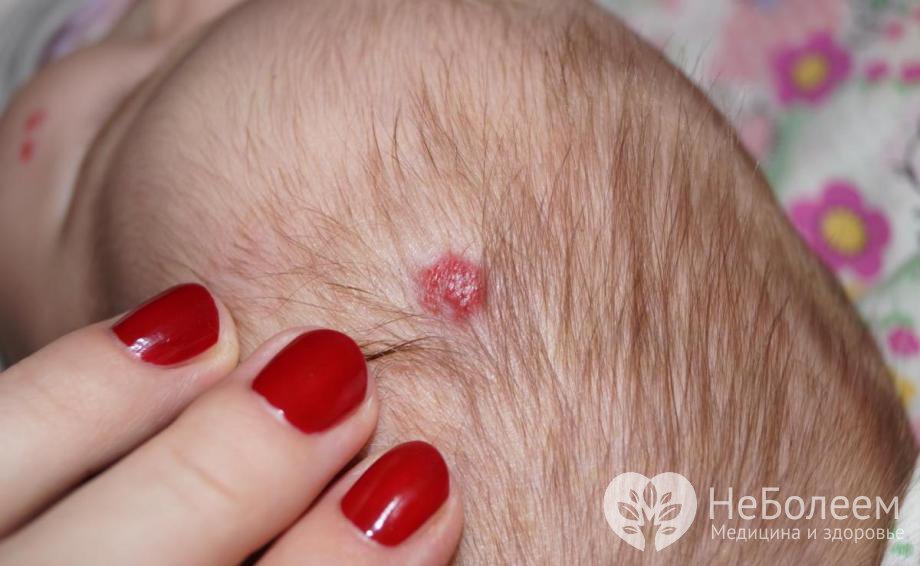 Симптомы гемангиомы у новорожденного