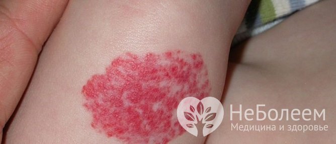 Как выглядит капиллярная гемангиома