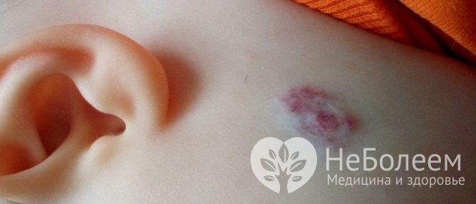 Кавернозная гемангиома у новорожденного