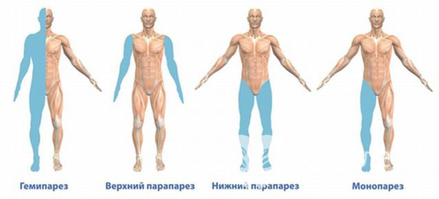 Виды парезов