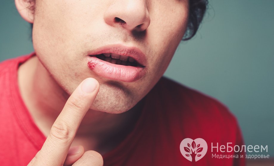 Симптомы герпеса