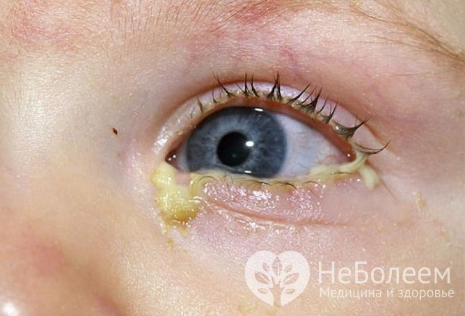 Гнойный конъюнктивит  у детей встречается особенно часто