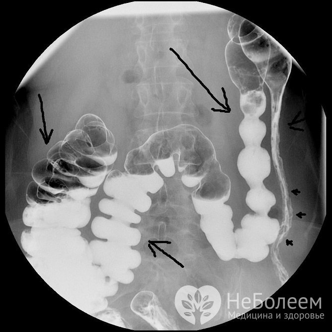 Хронический колит, результаты ирригоскопии