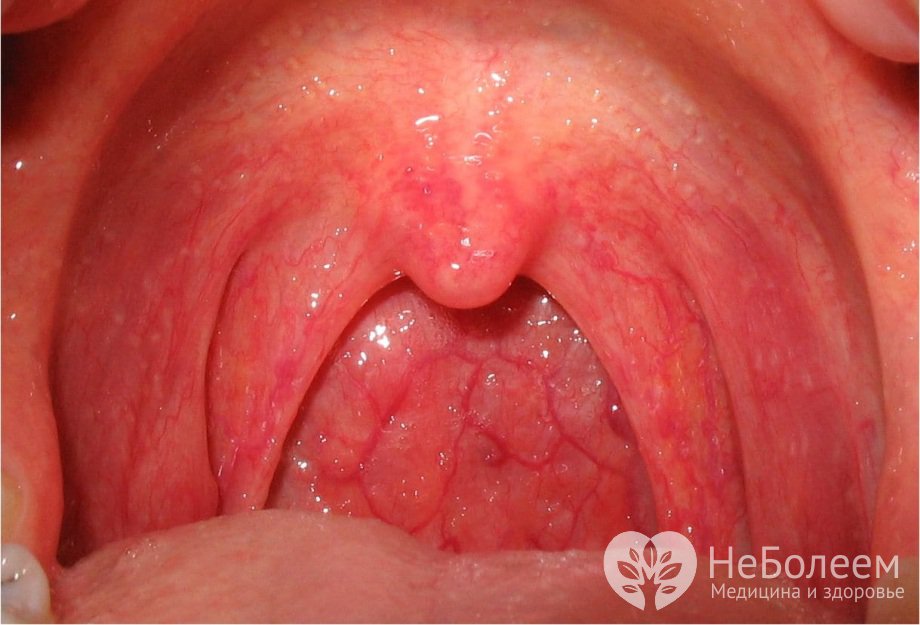 Симптомы катаральной ангины