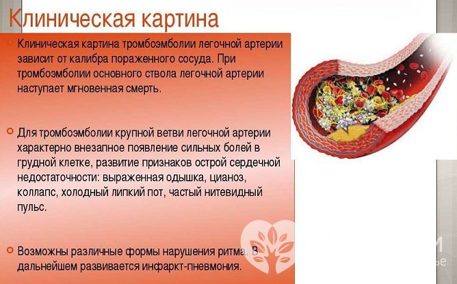 Симптомы легочной эмболии