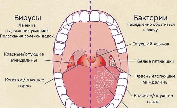 Острый фарингит – инфекционные причины и признаки